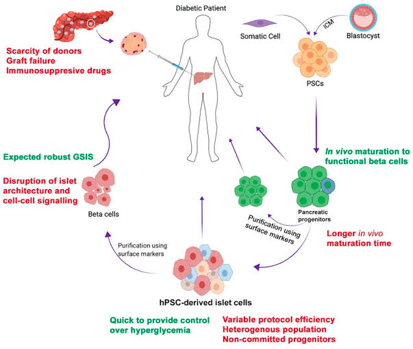 Stem cell therapy for diabetes